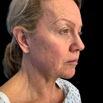 before-deep-plane-facelift-necklift-nanofat